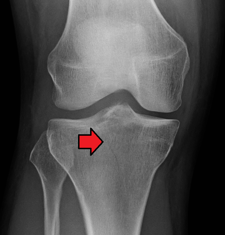 closed fracture tibial plateau