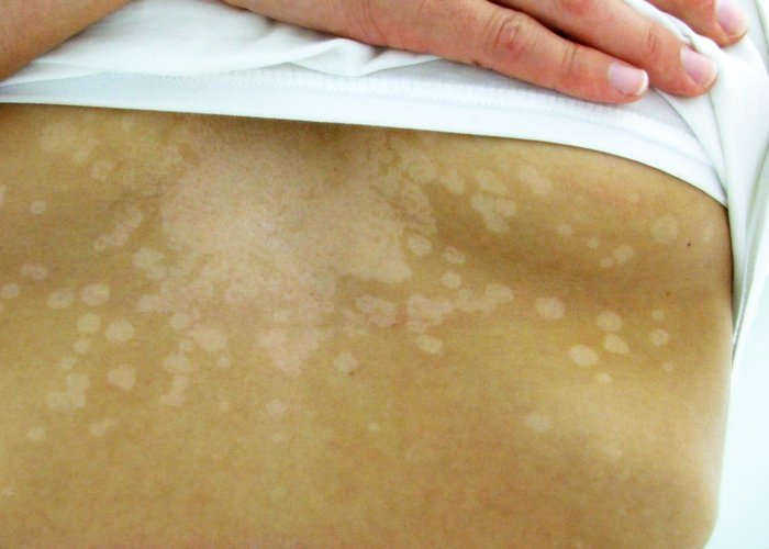 Facts about Tinea Versicolor Infection