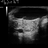 Ultrasound Scan showing Baker's Cyst.