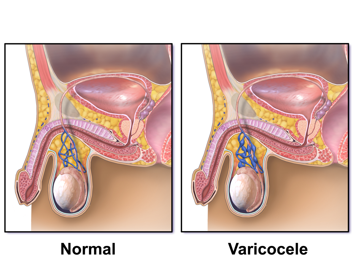 Varicocele Of Scrotum