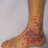 Image showing purpura on the low limb due to medication induced vasculitis.