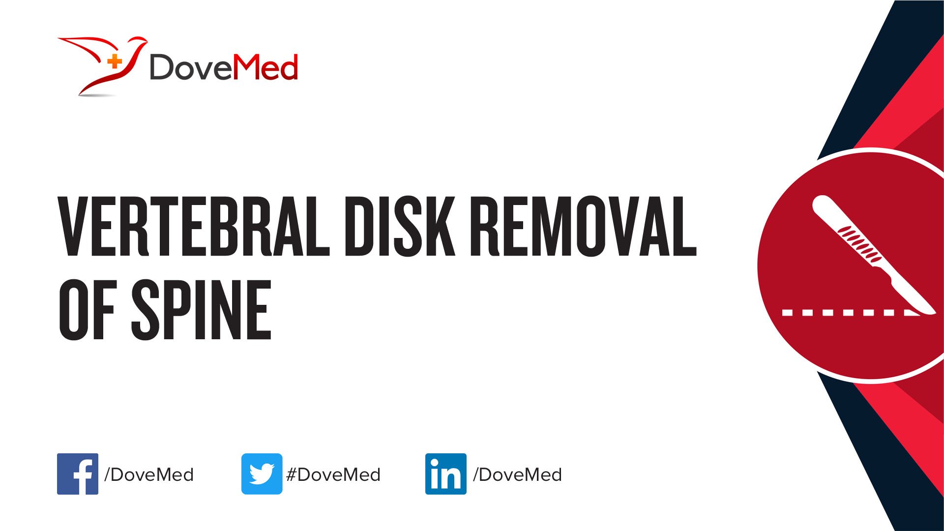 Vertebral Disk Removal (Laminectomy) of Spine