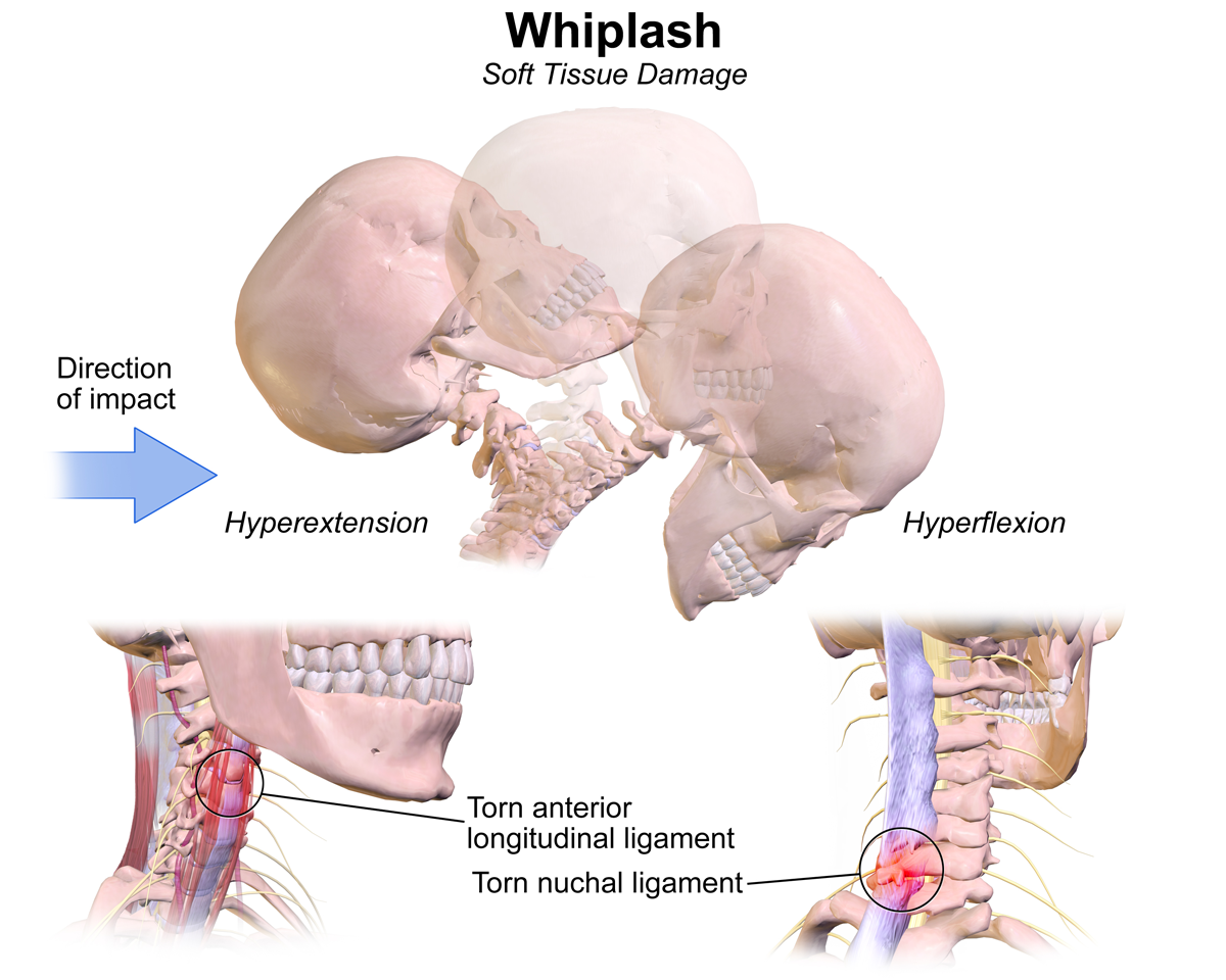 whiplash