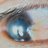 Image showing pterygium of the right eye.