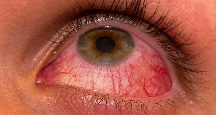 Conjunctivitis.