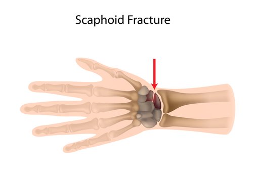 broken scaphoid bone