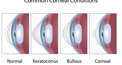 Common corneal conditions, eye cornea diseases