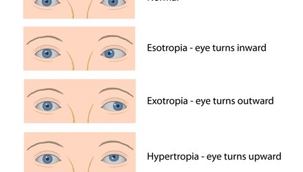 Strabismus Surgery