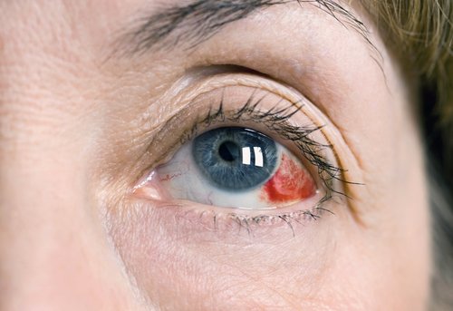 Image result for Subconjunctival haemorrhage