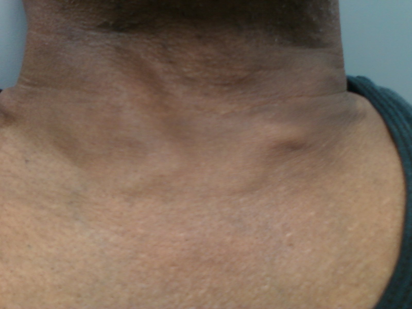 Subcutaneous Emphysema