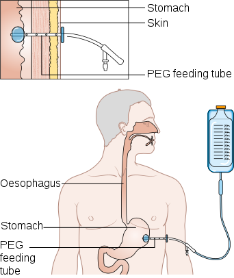 Percutaneous (through the skin) Endoscopic Gastrostomy (PEG Procedure)