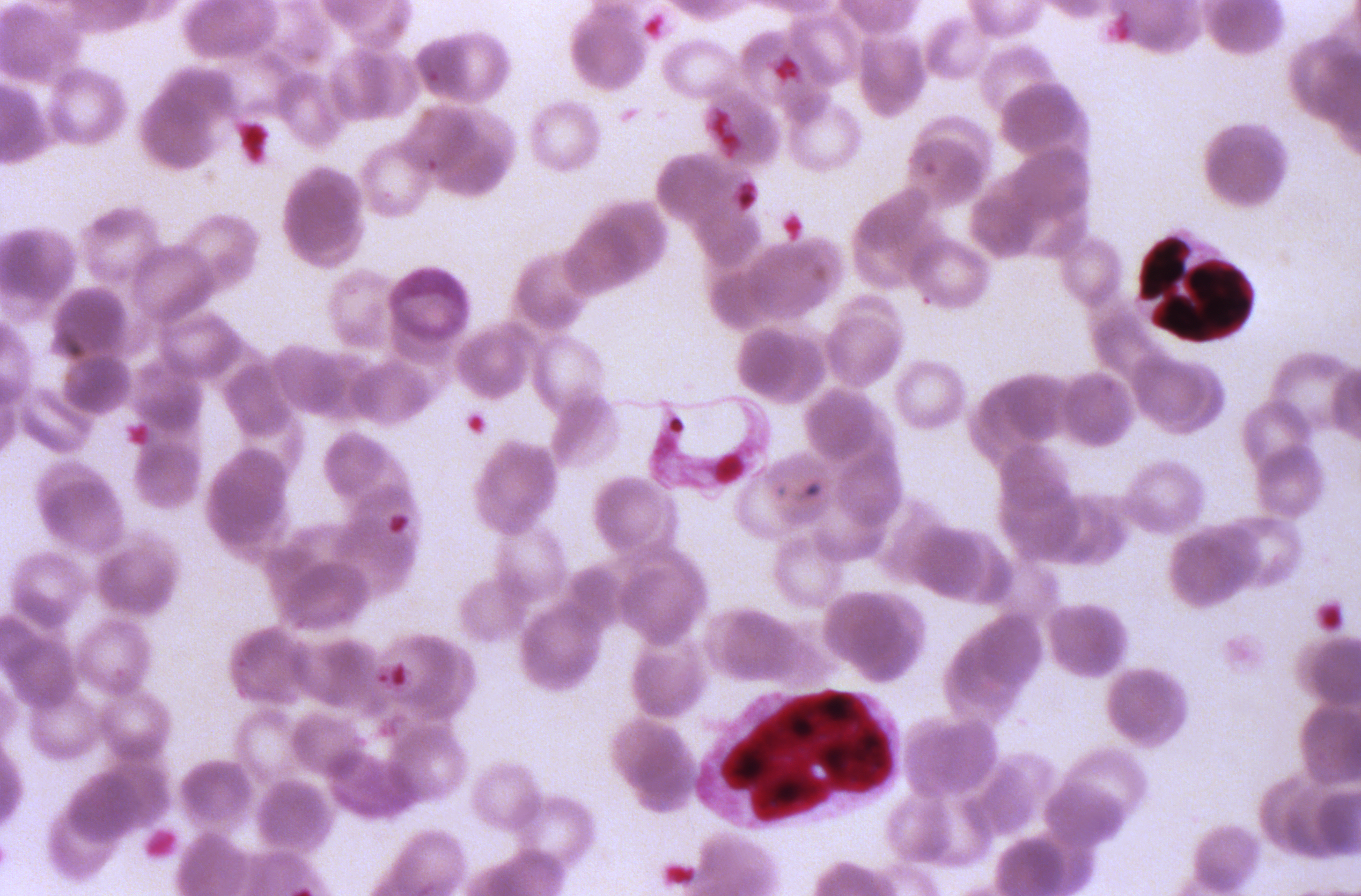 American Trypanosomiasis