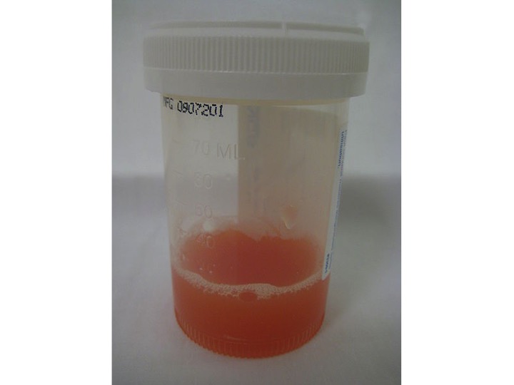 Synovial Fluid Analysis of Ankle Joint