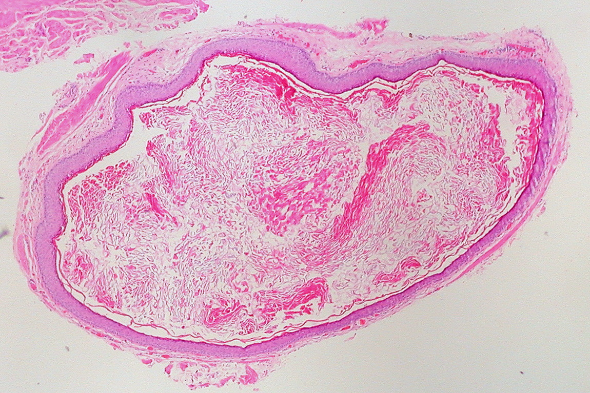 Benign ear cyst or tumor as related to Epidermoid Cyst - Pictures