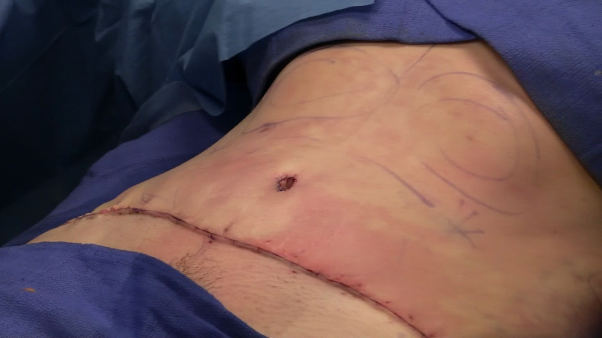abdominoplasty surgery