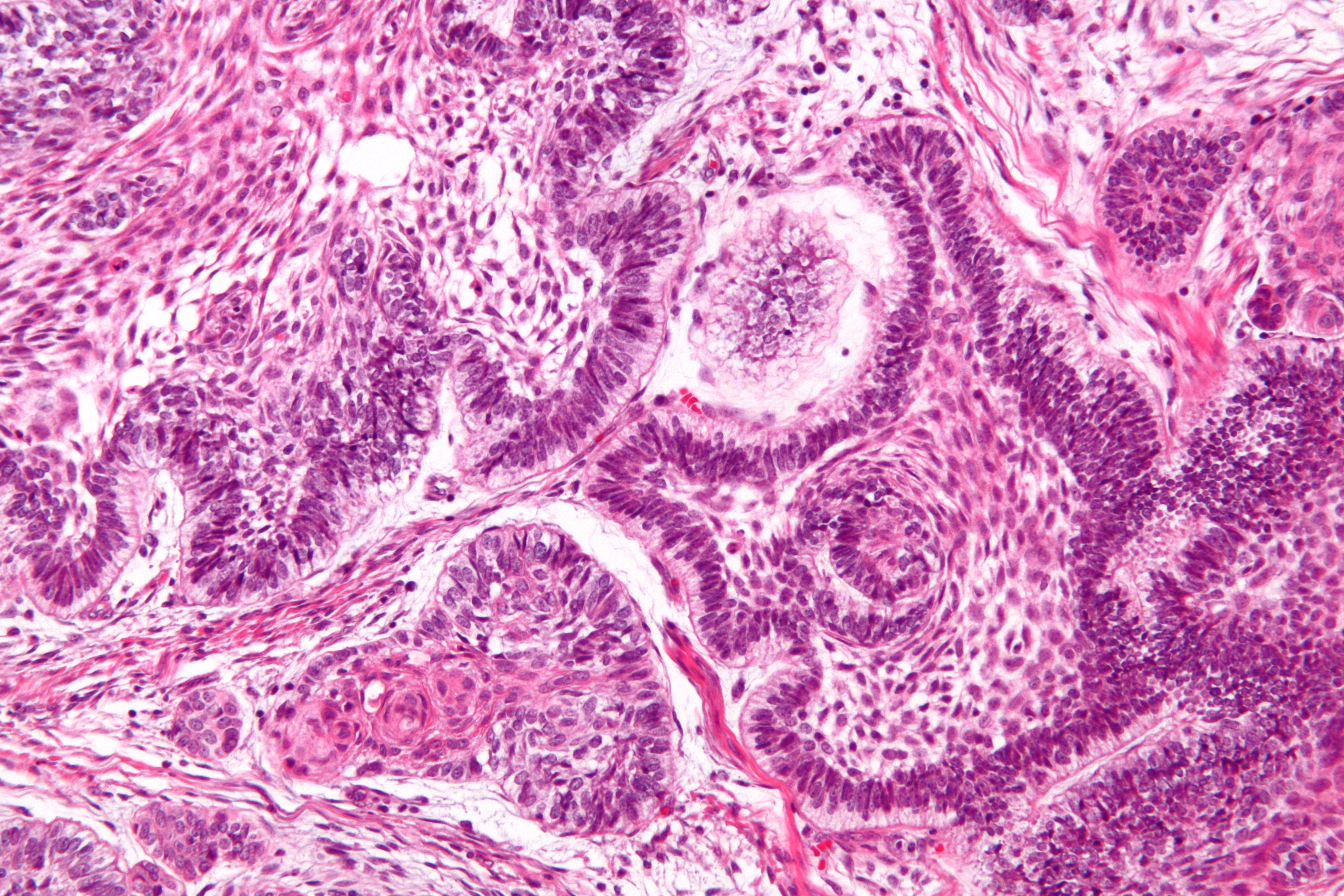 Ameloblastoma