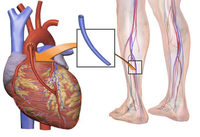 many-good-years-after-heart-bypass-surgery-but-something-happens-after