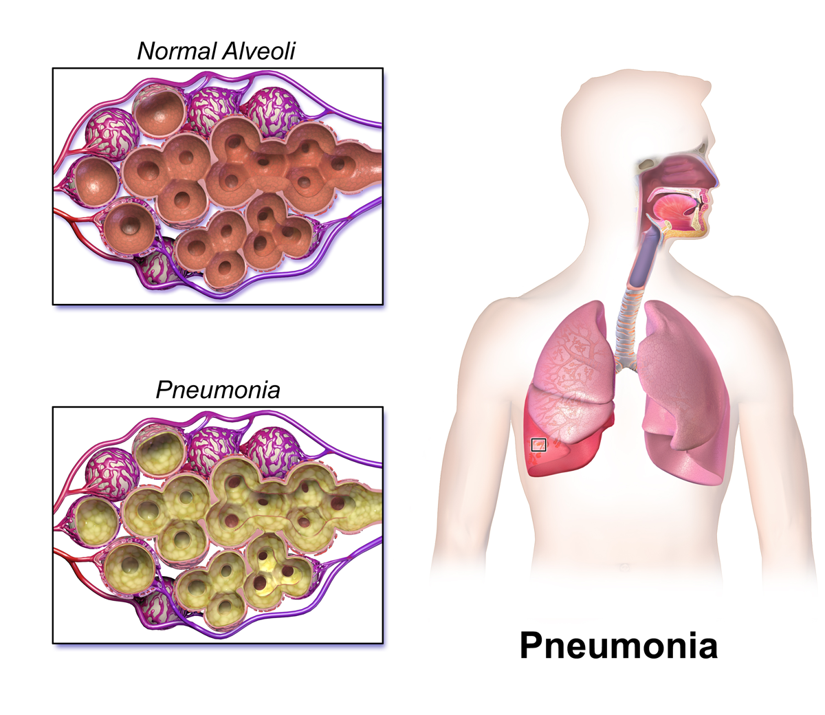 Viral Pneumonia