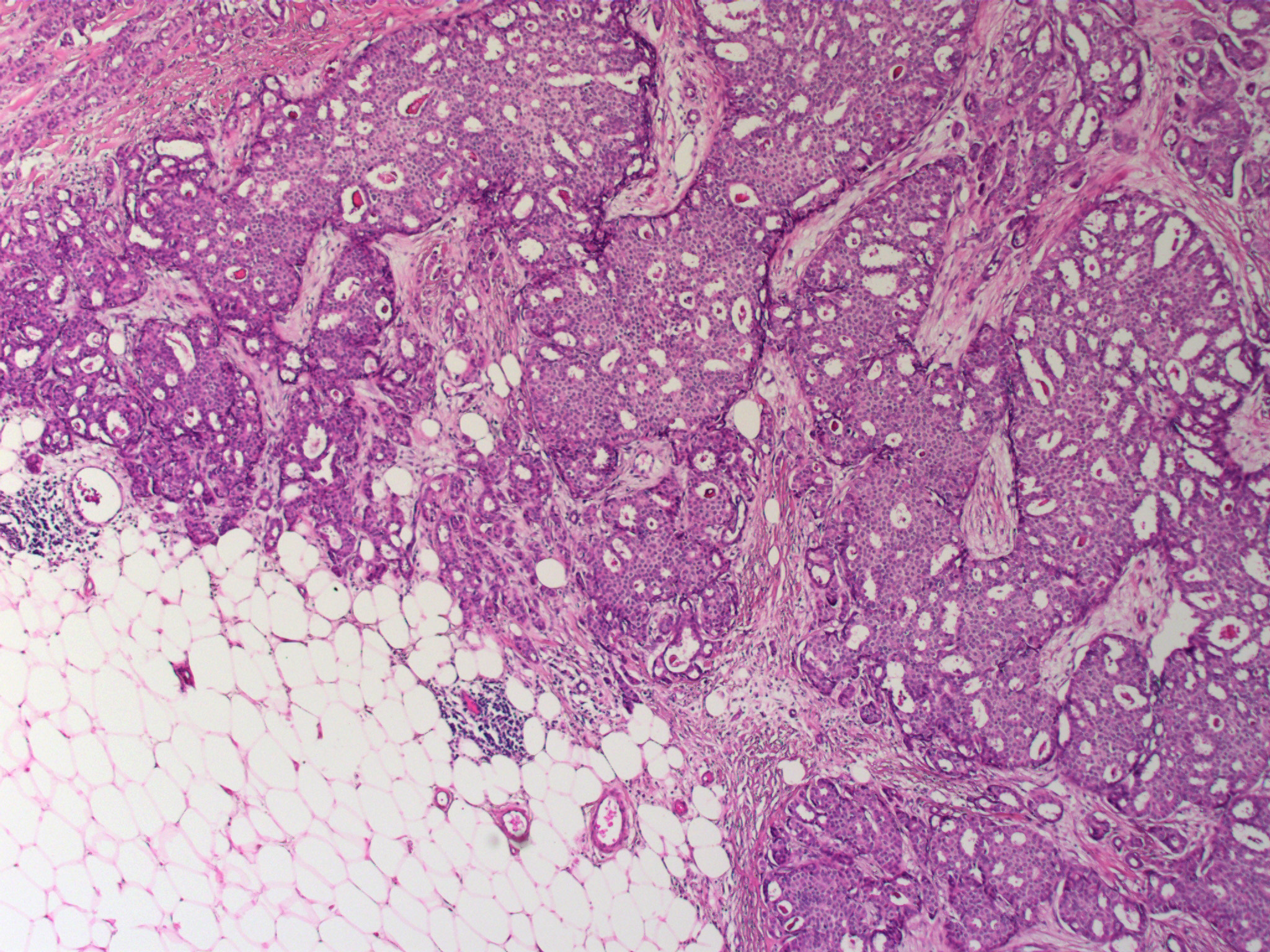 Invasive Cribriform Carcinoma of Breast