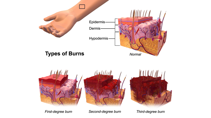treatment for fourth degree burns