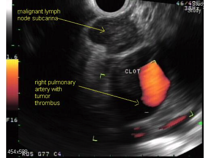 Needle Biopsy of Lung Mass