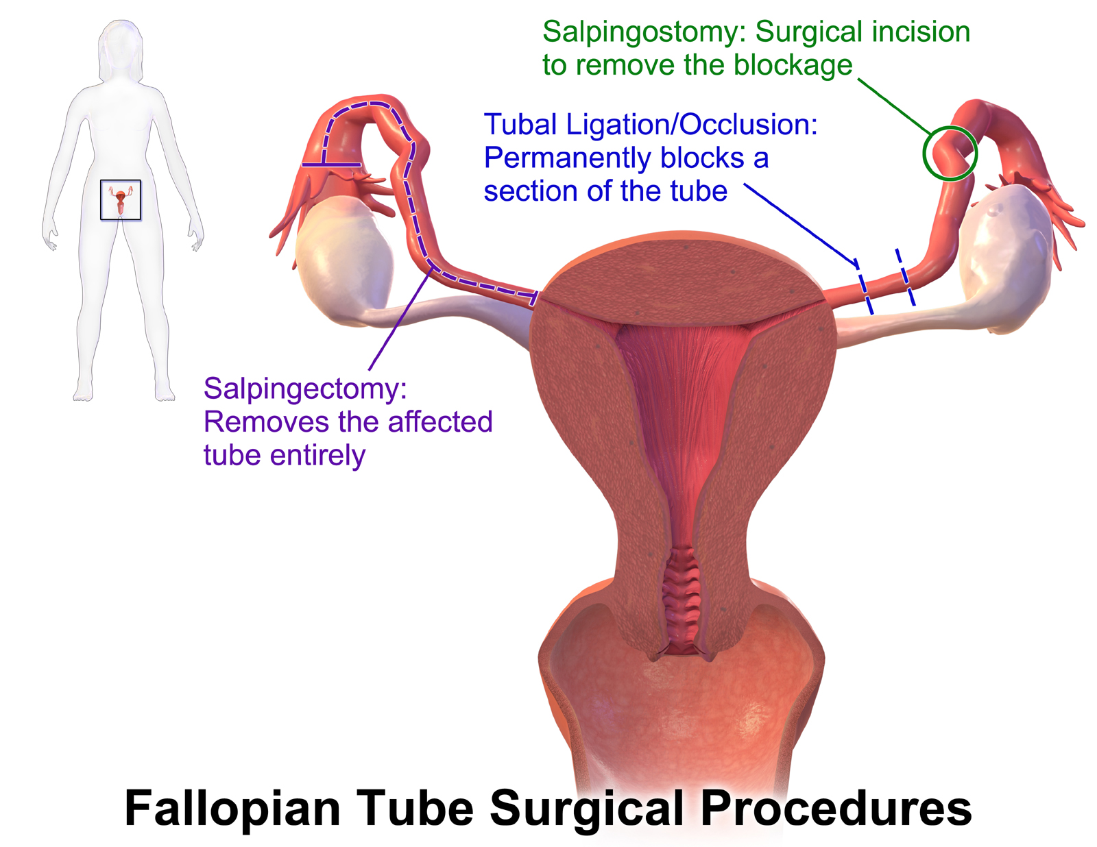 Tubal Ligation