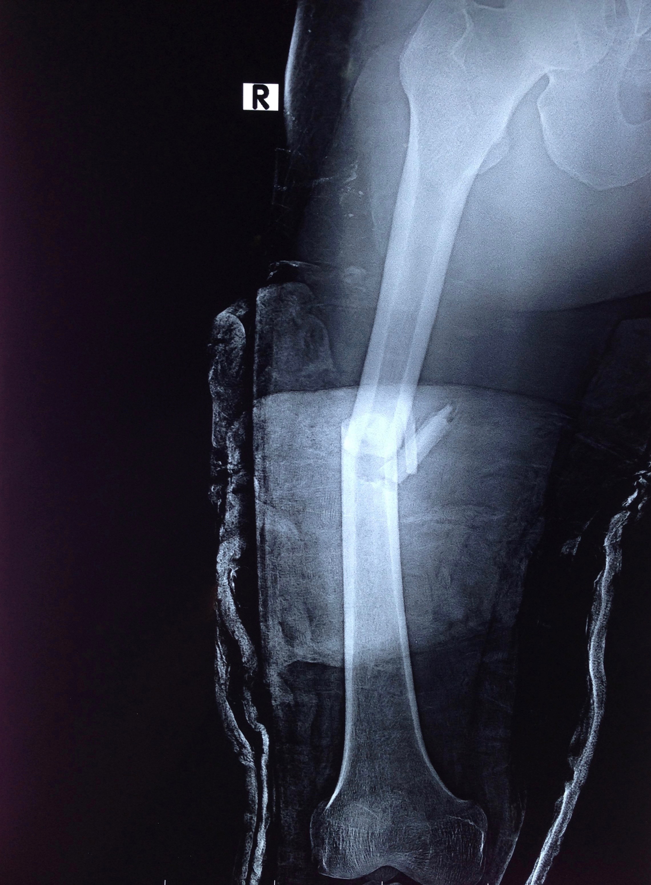 Fracture Of The Femoral Shaft