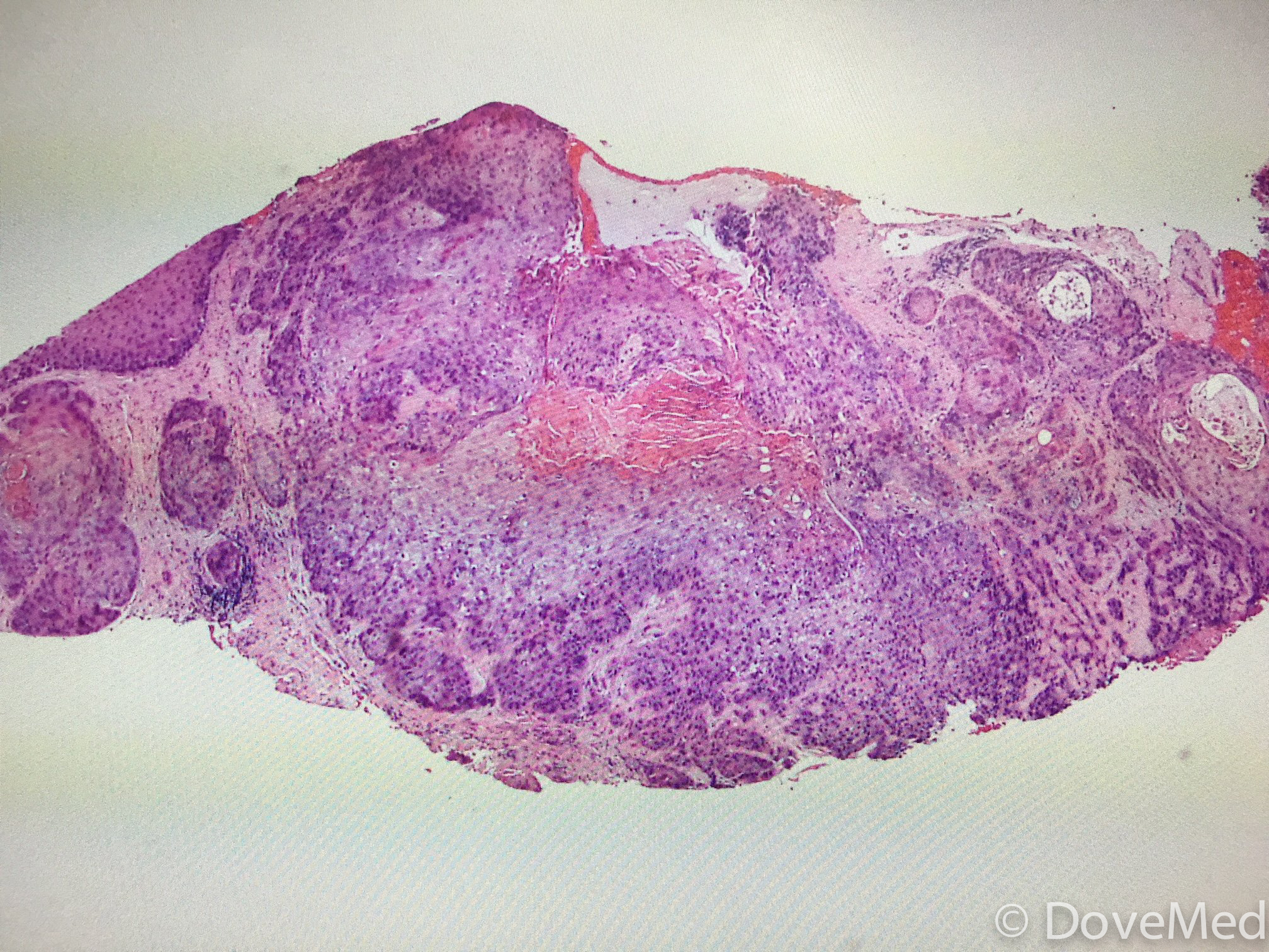 Squamous Cell Carcinoma of Lip