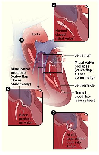 Mitral Valve Prolapse (MVP)