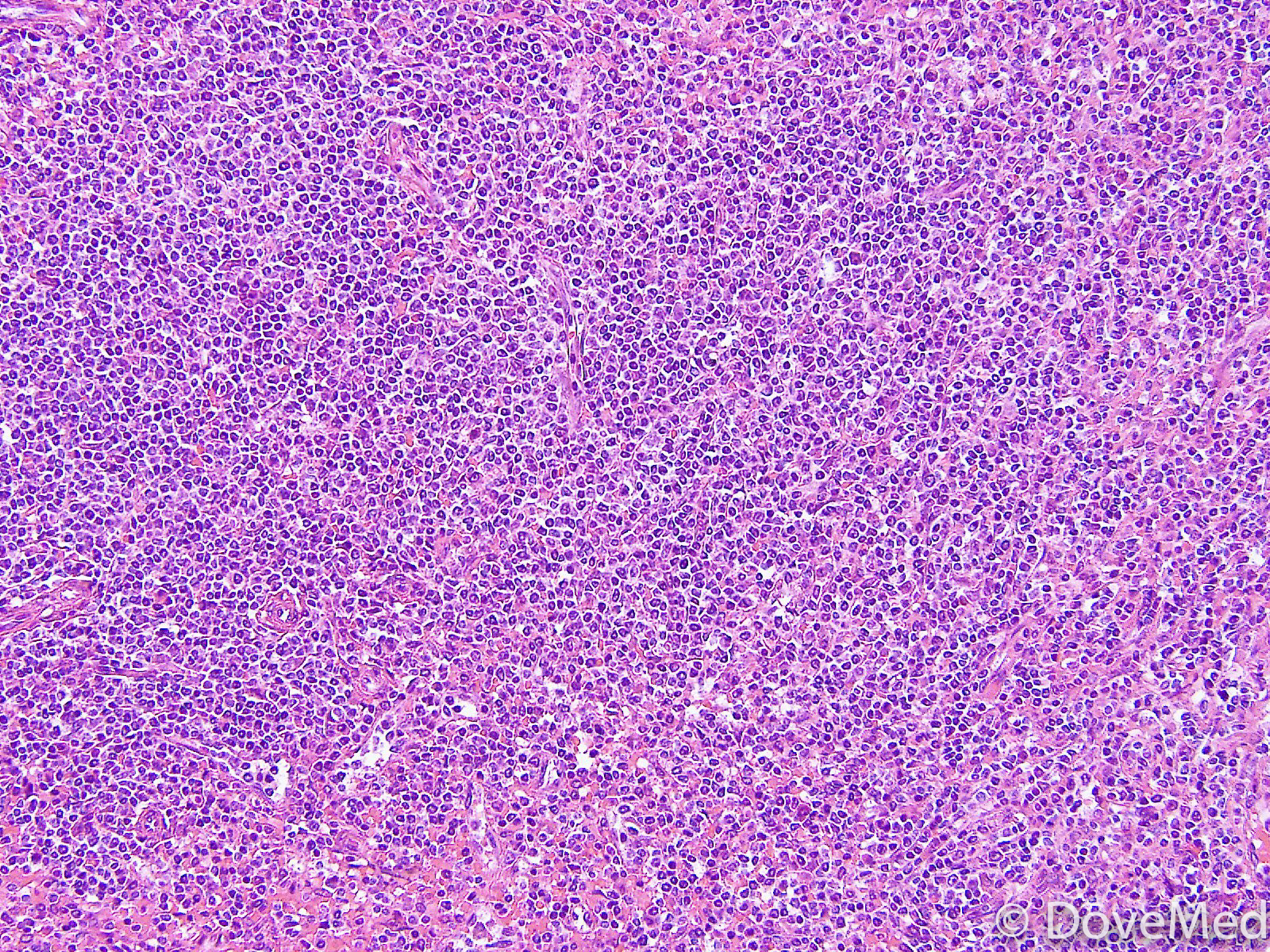 Lymphoma of Liver