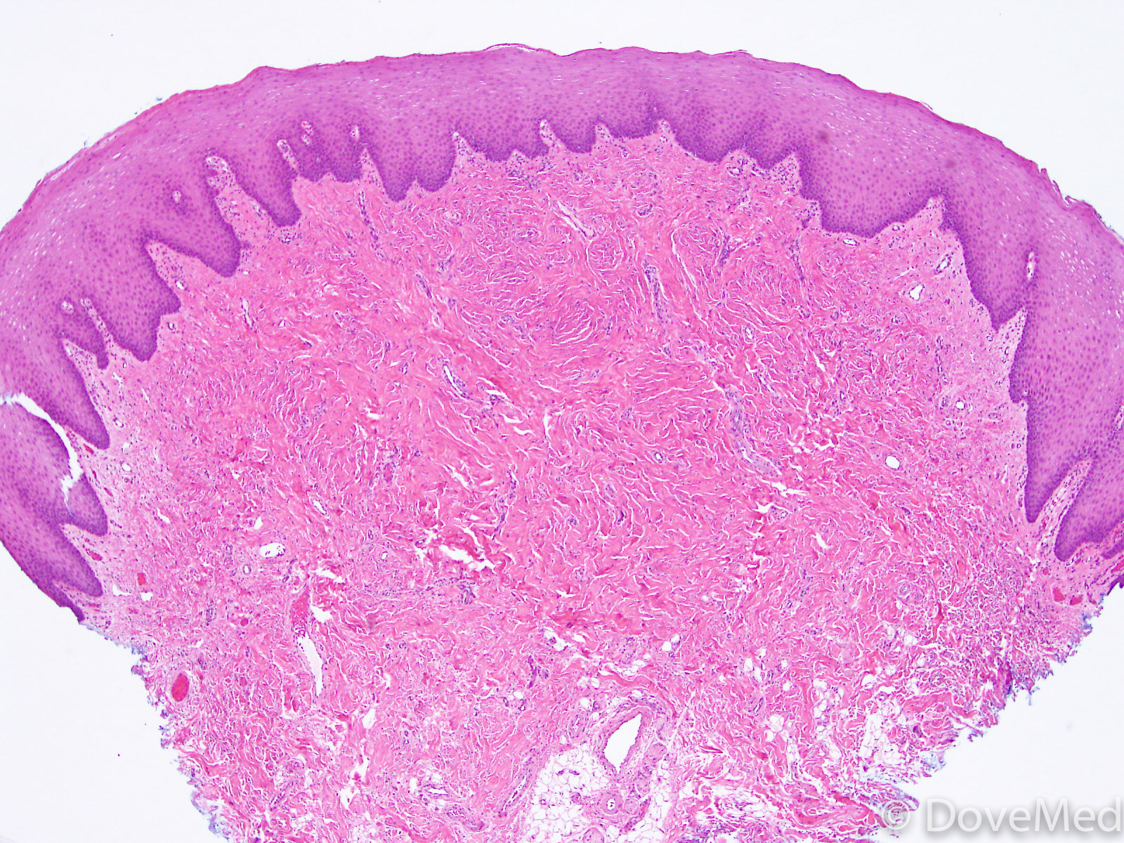 oral-giant-cell-fibroma