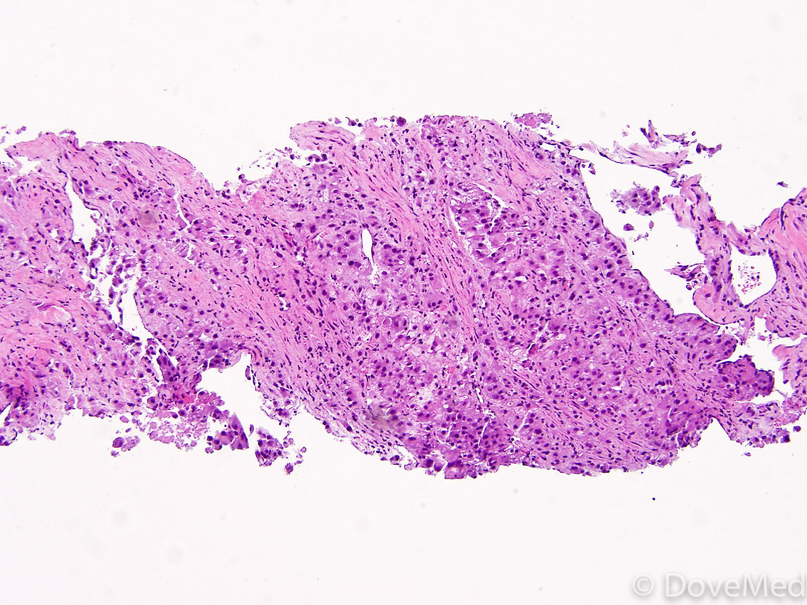 Invasive Mucinous Adenocarcinoma Of Lung