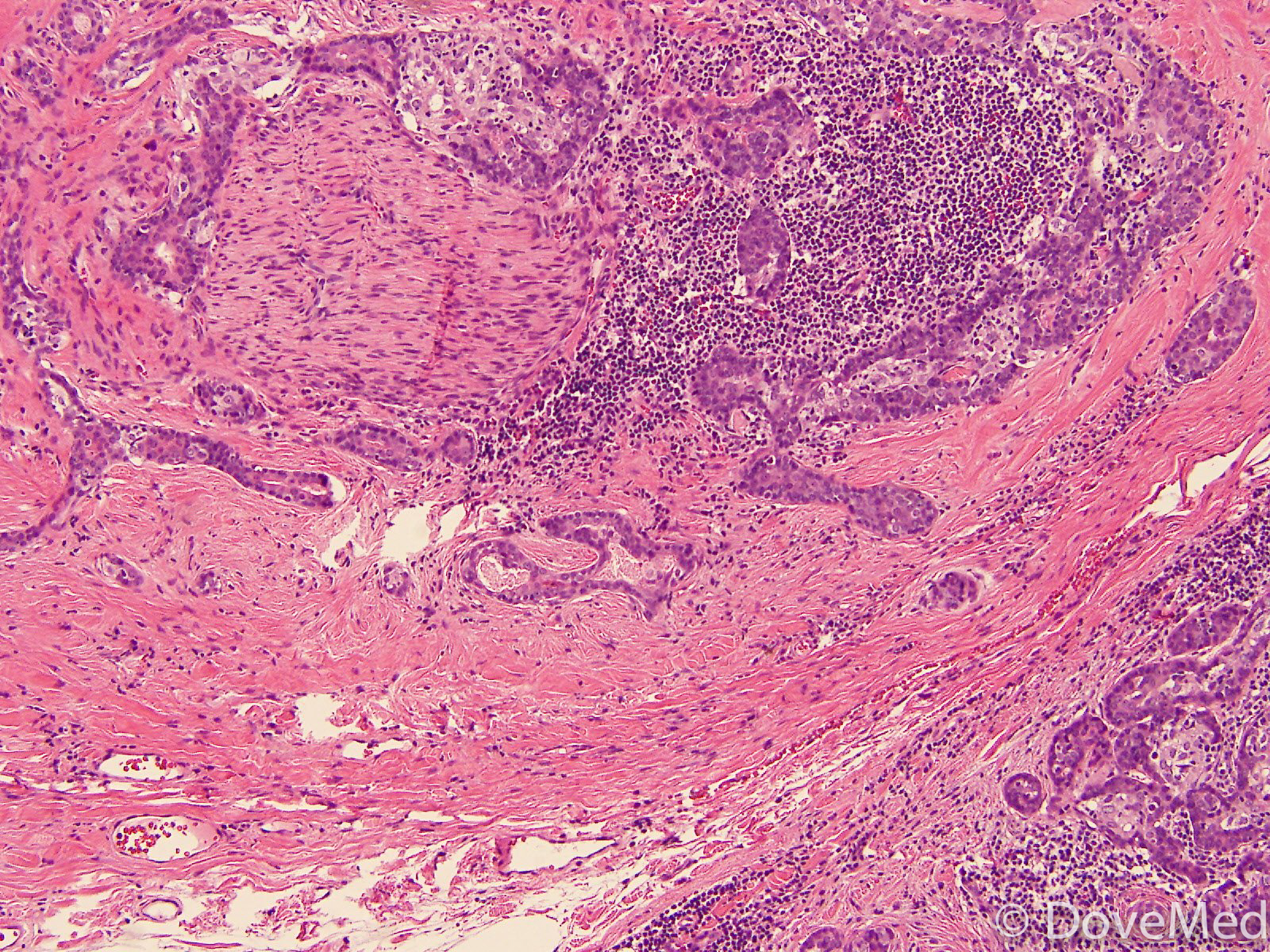 Adenoid Cystic Carcinoma of Skin