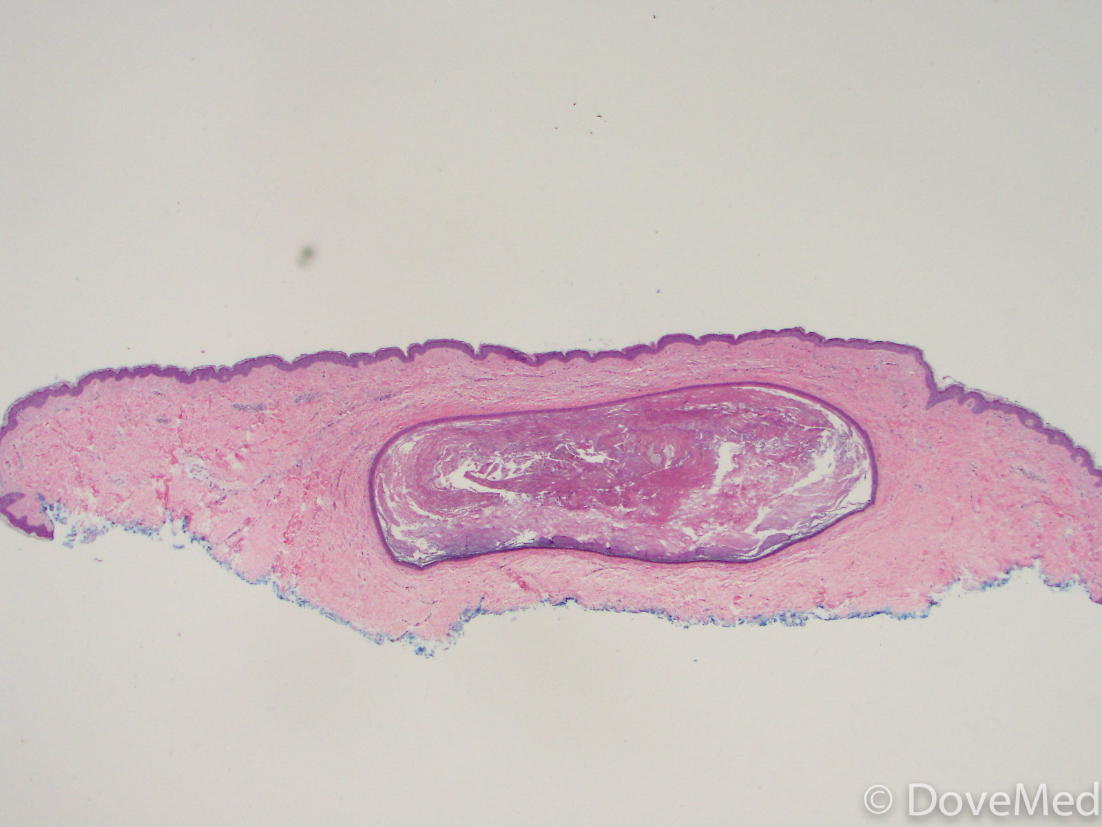 epithelial-inclusion-cysts-of-skin