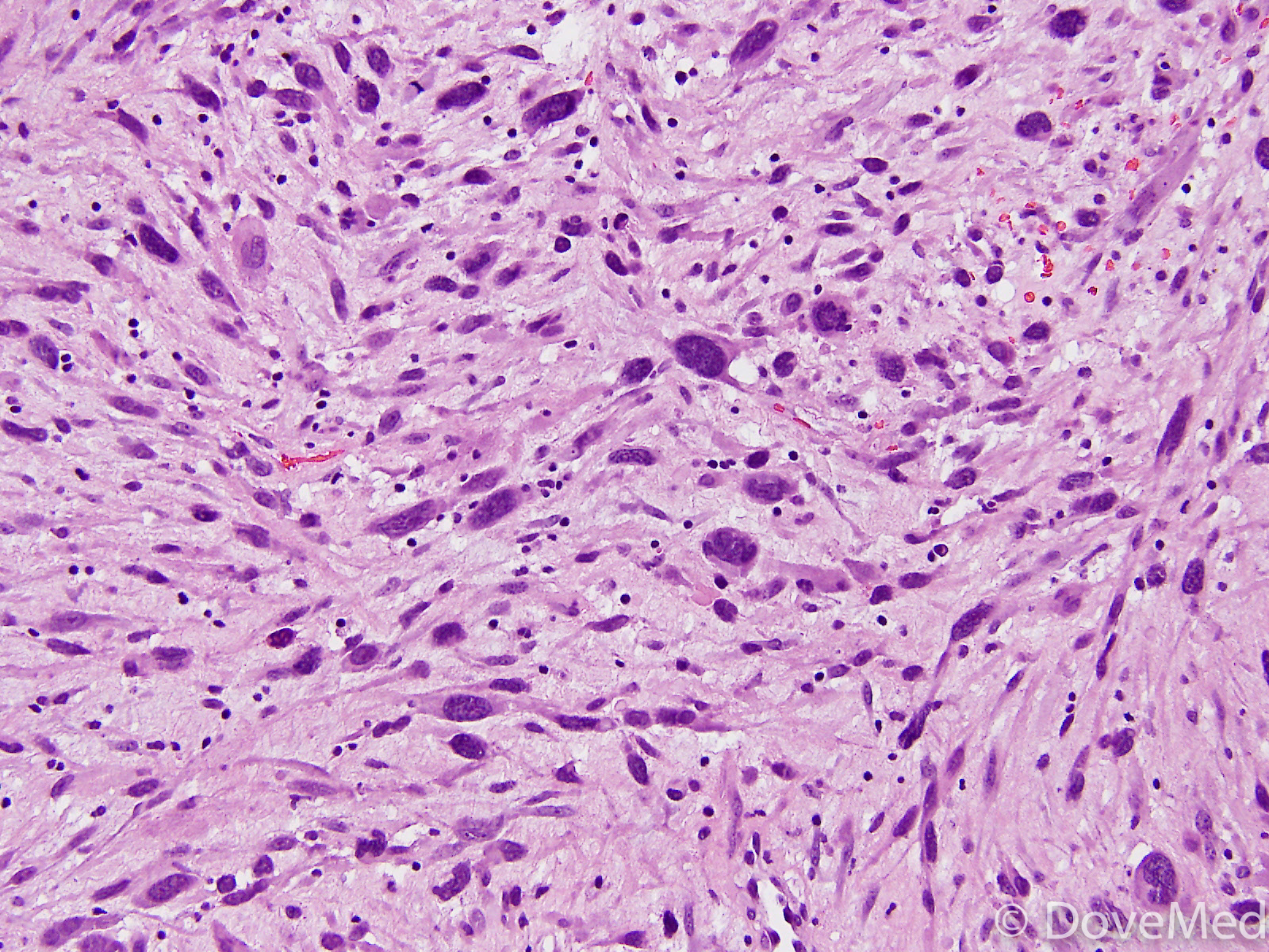 Sarcomatoid Carcinoma Of The Lung