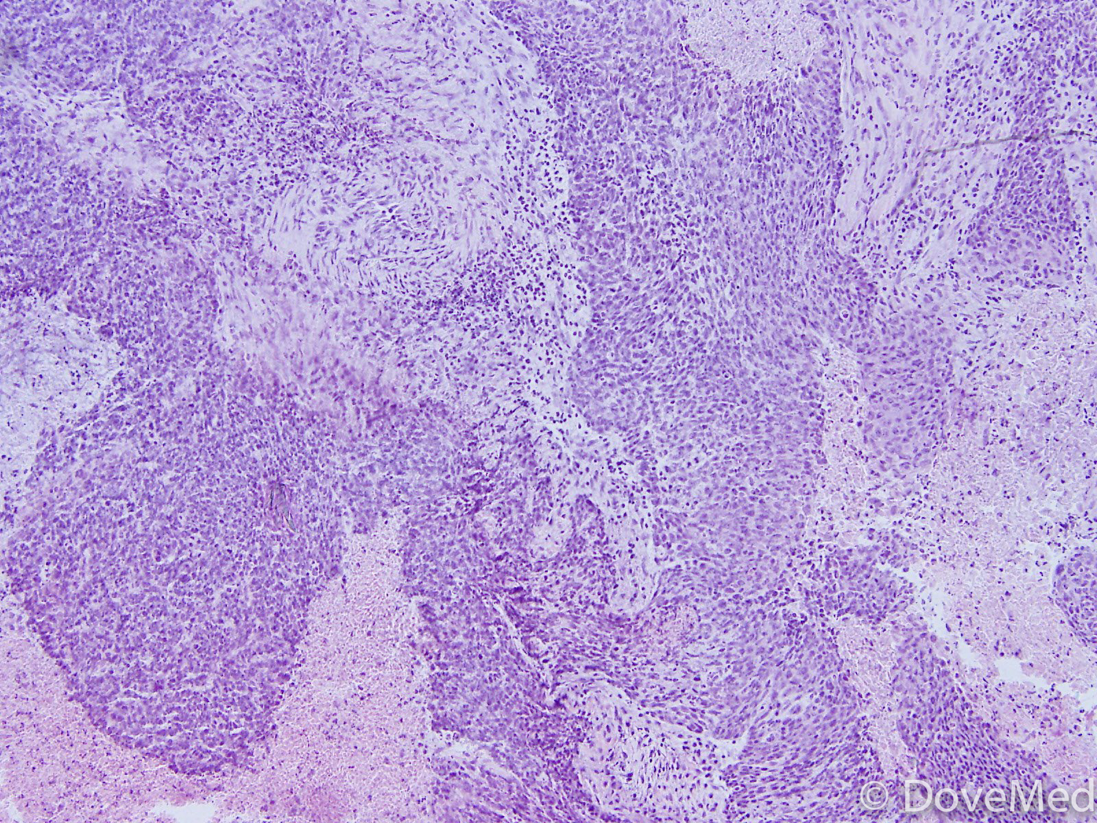 Invasive Squamous Cell Carcinoma of Anus