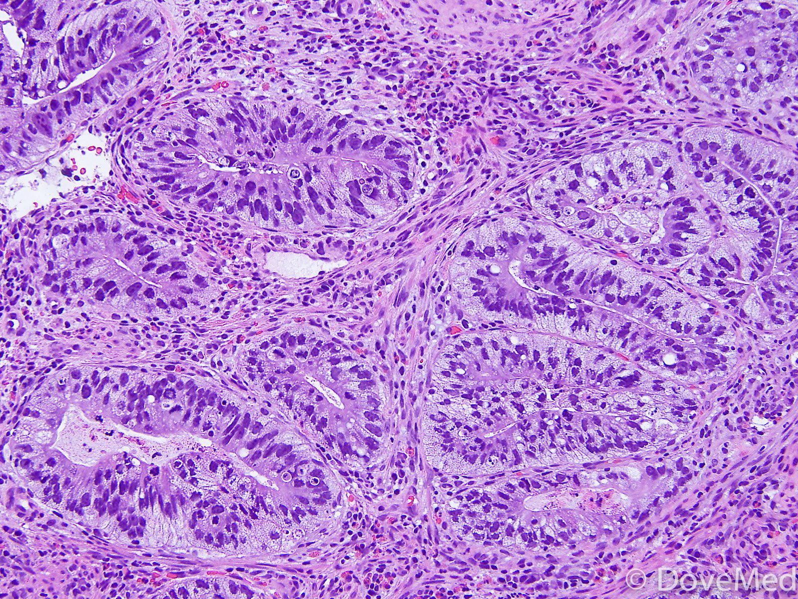 invasive-adenocarcinoma-of-lung