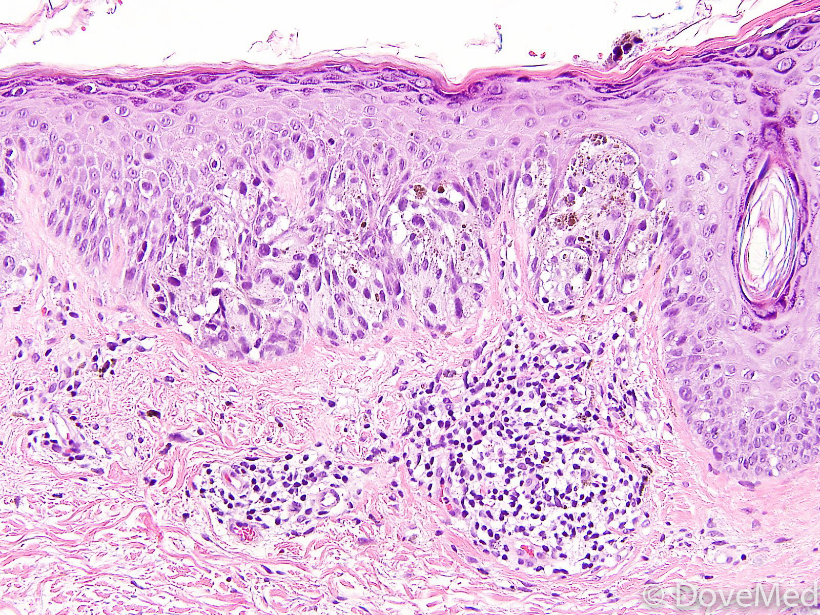 Melanoma In Situ of Skin