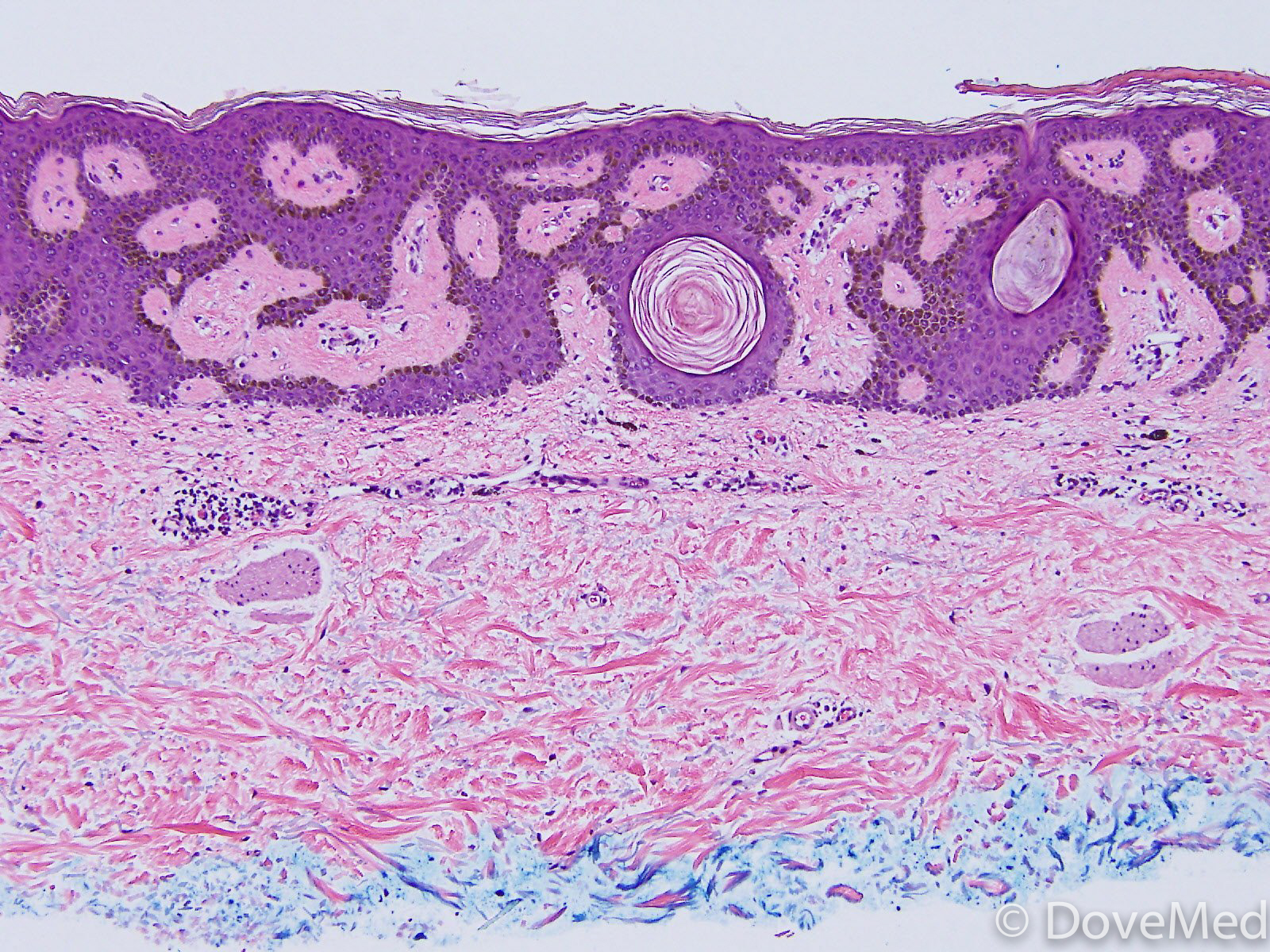 Seborrheic Keratosis