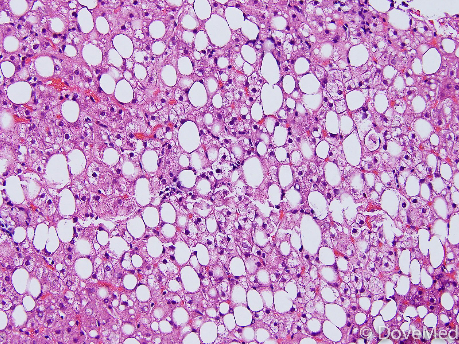 Pediatric Non Alcoholic Steatohepatitis