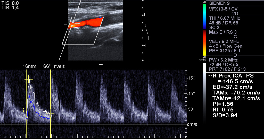 Carotid Artery Ultrasound