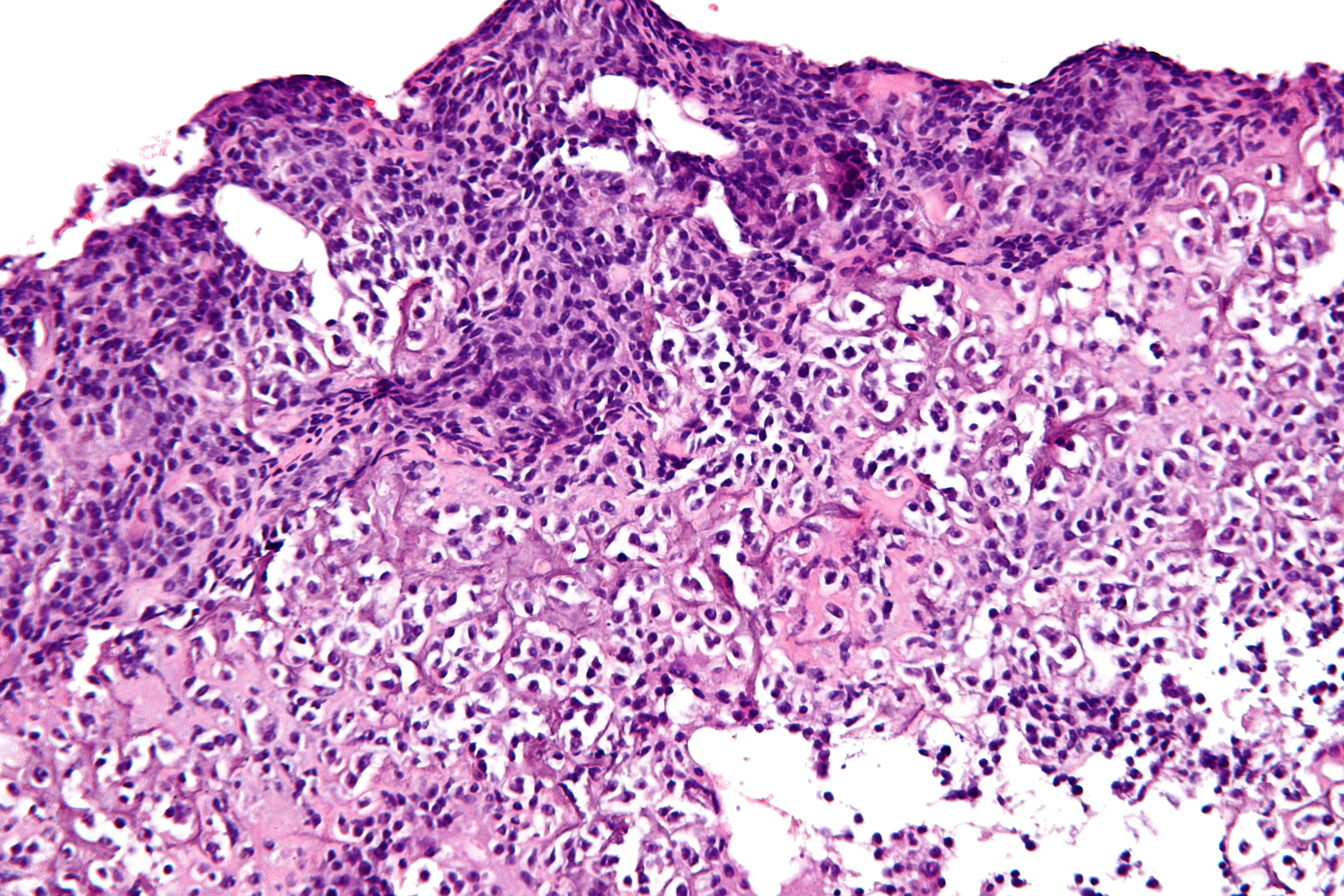 Small Cell Osteosarcoma