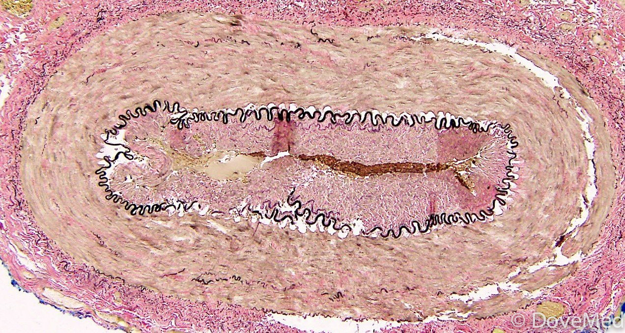 pathology-glossary-giant-cell-arteritis-draw-it-to-know-it