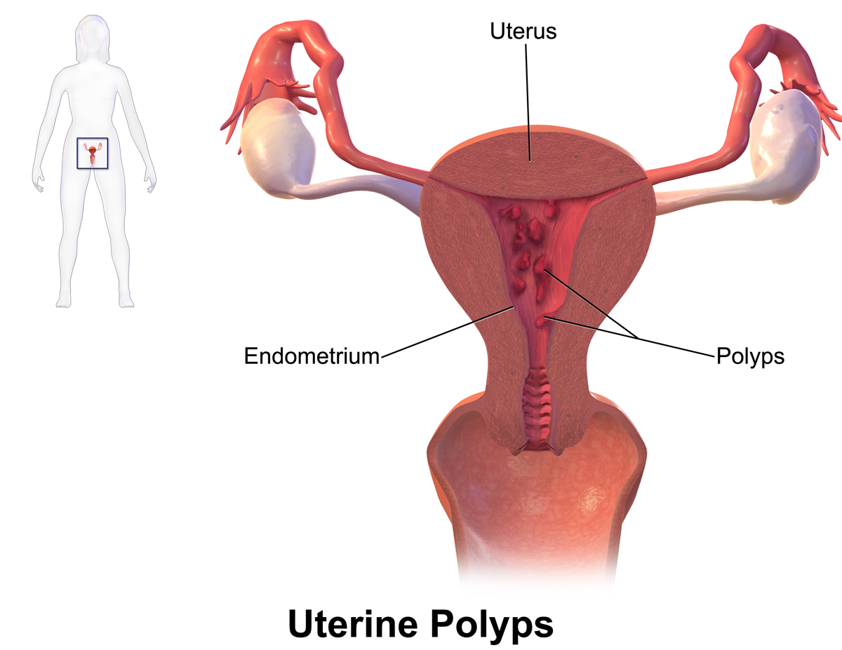 uterine-prolapse