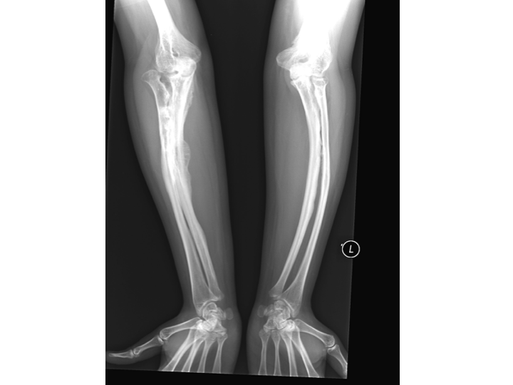 Osteogenesis Imperfecta