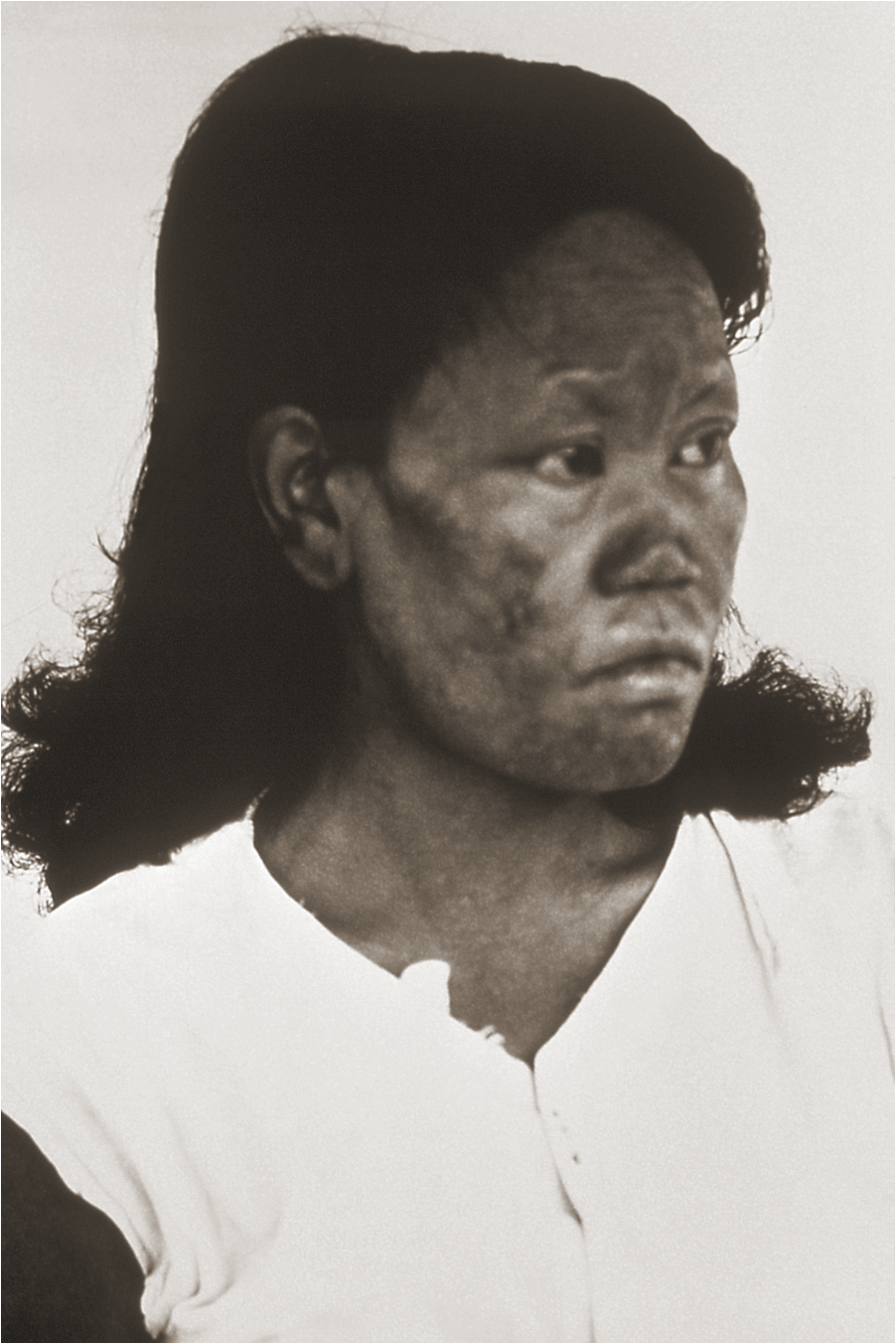 Leprosy