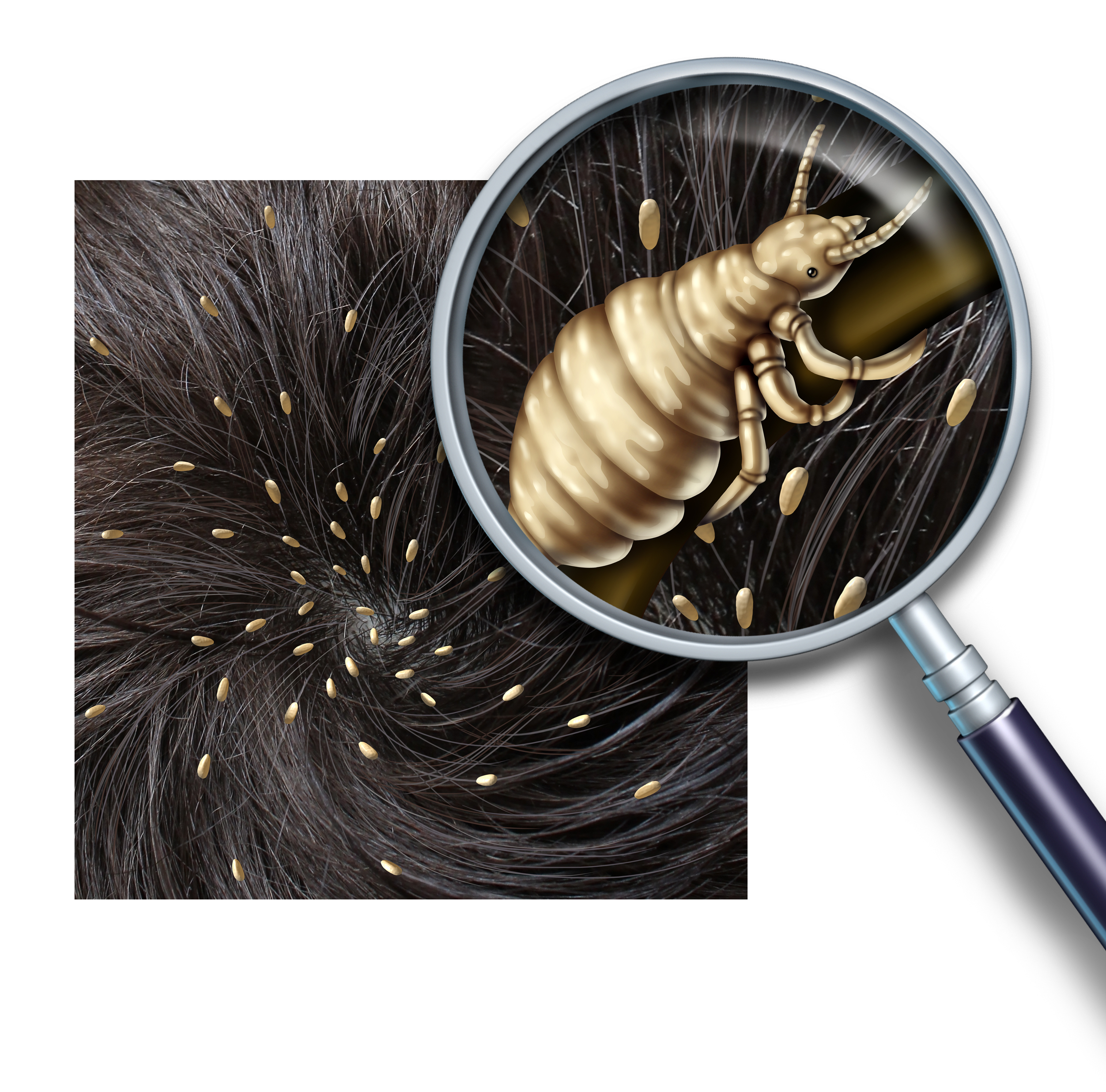 head-lice-infestation