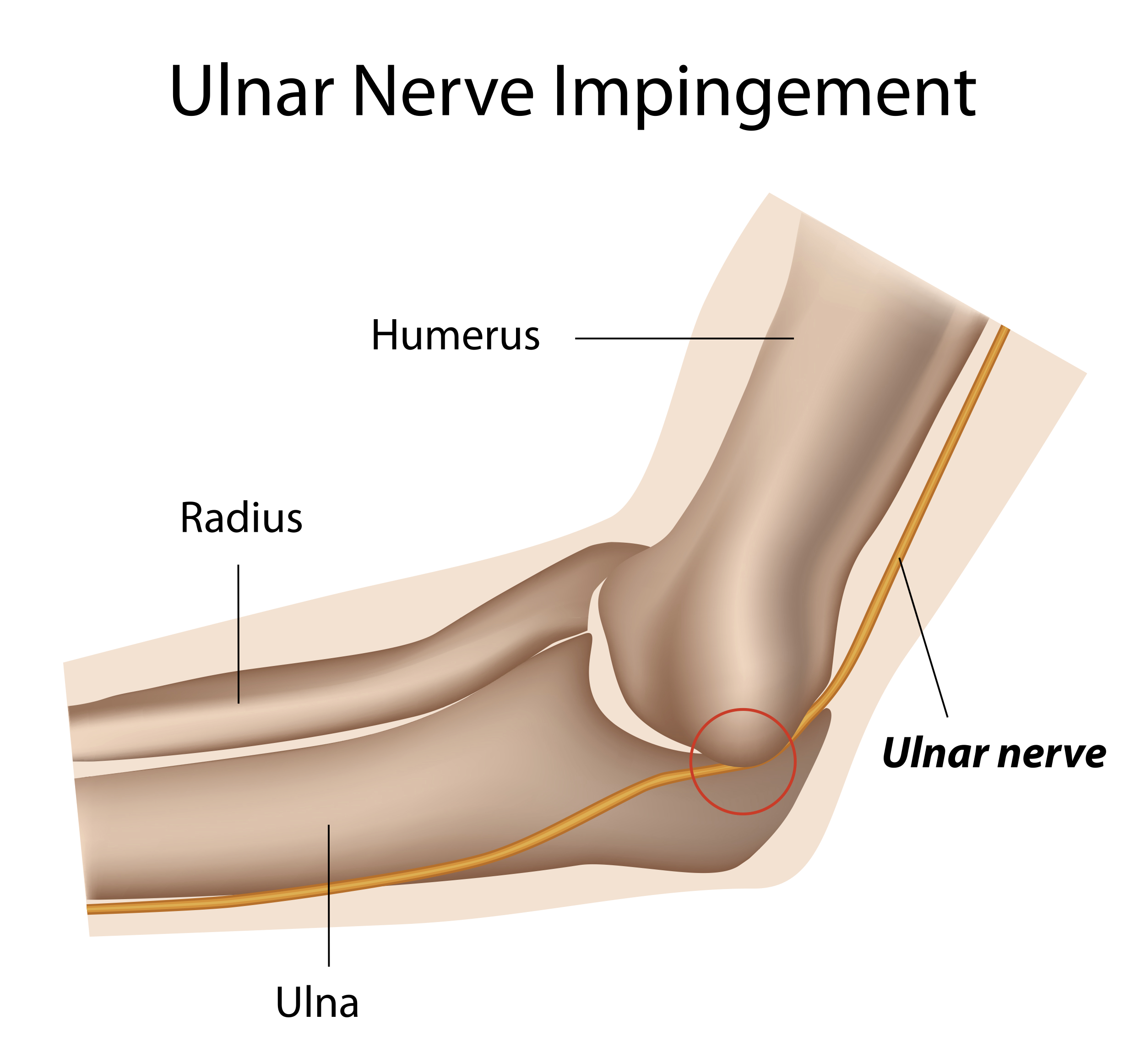 Ulnar Nerve Palsy Fingers